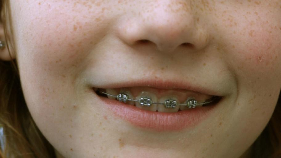 Ein Kind mit einer festen Zahnspange