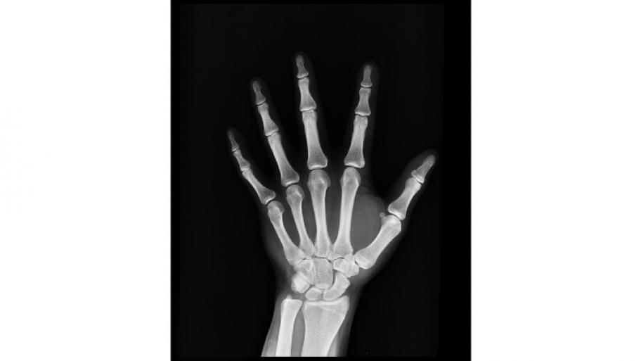 Röntgenbild einer linken Hand, hell die Knochen, schwarz der Hintergrund